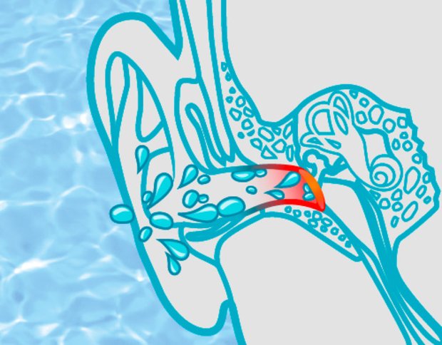 Water in ear: Without SwimGuard earplugs the water can penetrate the ear canal when swimming.